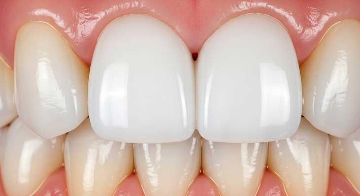 سفید کردن ایمپلنت دندان