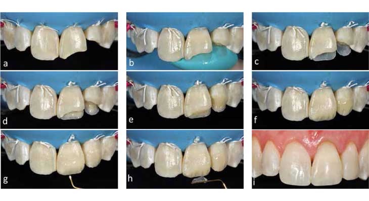 کامپوزیت دندان به روش لیرینگ چیست؟