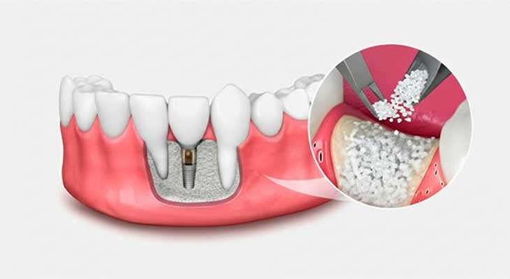 پیوند استخوان در ایمپلنت دندان