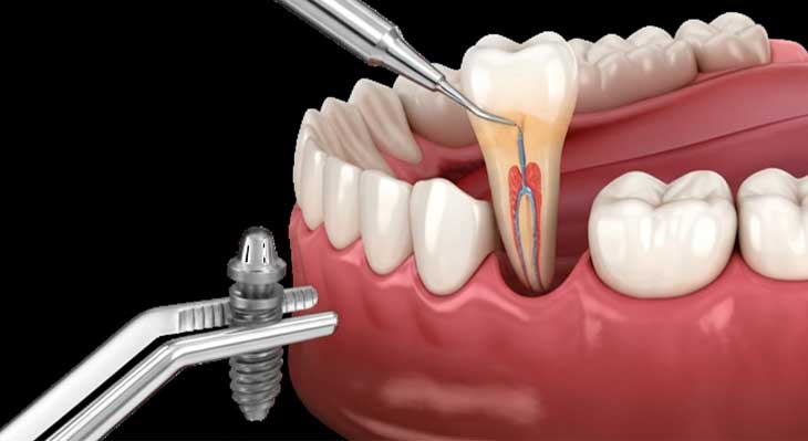 فاصله بین کشیدن دندان تا ایمپلنت