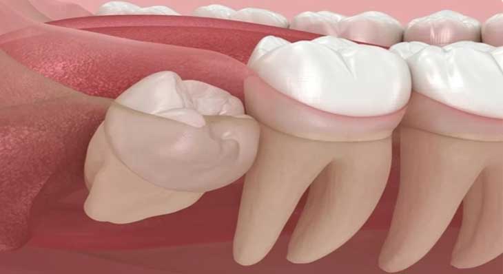 دندان عقل نهفته