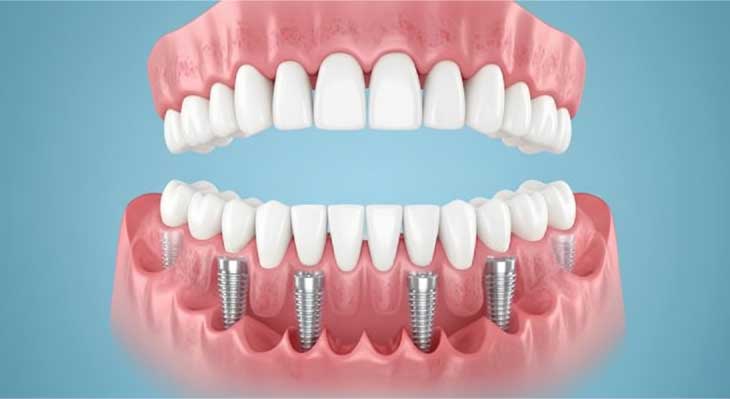 ایمپلنت All-on-6