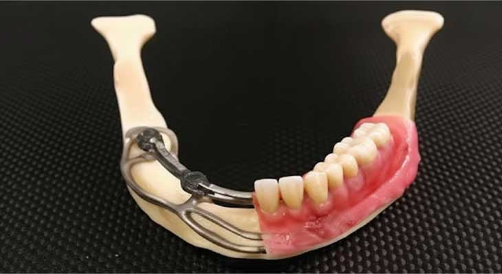 ایمپلنت ساب پریواستیل