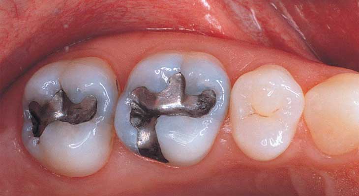 آمالگام چیست؟