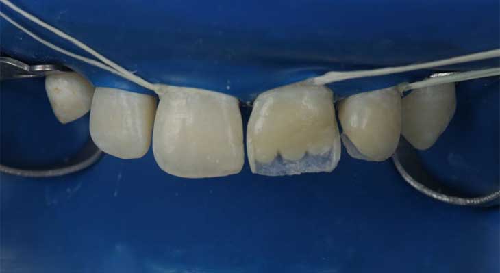 کامپوزیت دندان به روش لیرینگ چیست؟