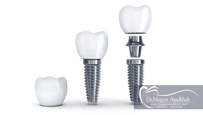 قیمت ایمپلنت دندان چقدر است