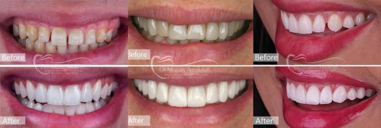 هزینه لمینت دندان