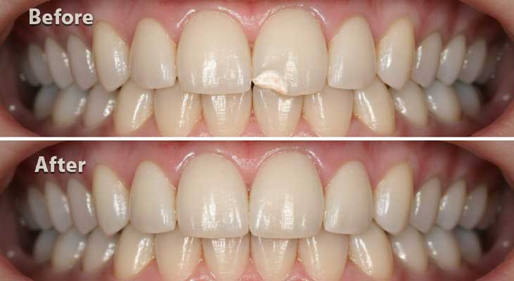 ترمیم کامپوزیت دندان