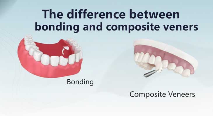 تفاوت باندینگ و کامپوزیت ونیر