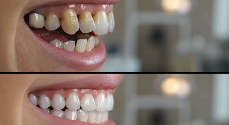 تاثیر سیگار بر کامپوزیت دندان