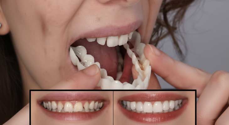 کامپوزیت متحرک دندان