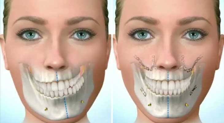 درمان فک نامتقارن و کج