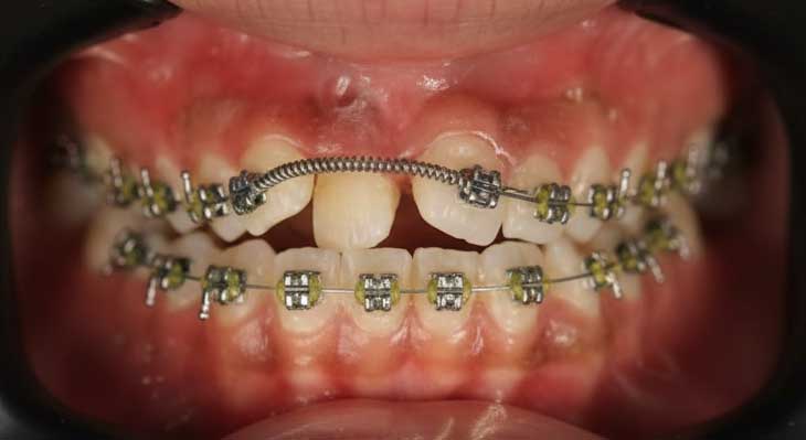 ارتودنسی بدون کشیدن دندان