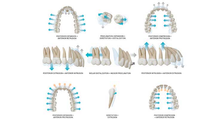جابجایی و چرخش دندان