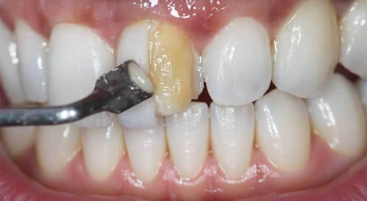 ترمیم کامپوزیت دندان