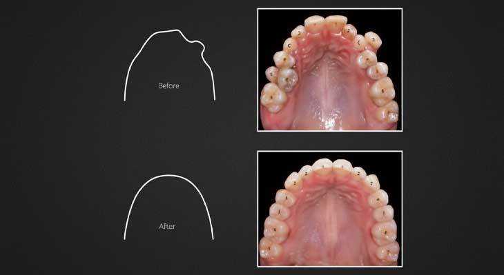 ارتودنسی بدون کشیدن دندان