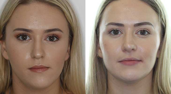 درمان فک نامتقارن و کج