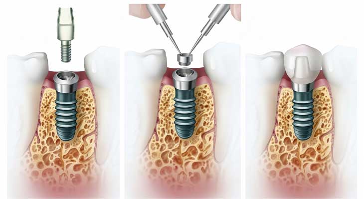 ایمپلنت تک مرحله ای