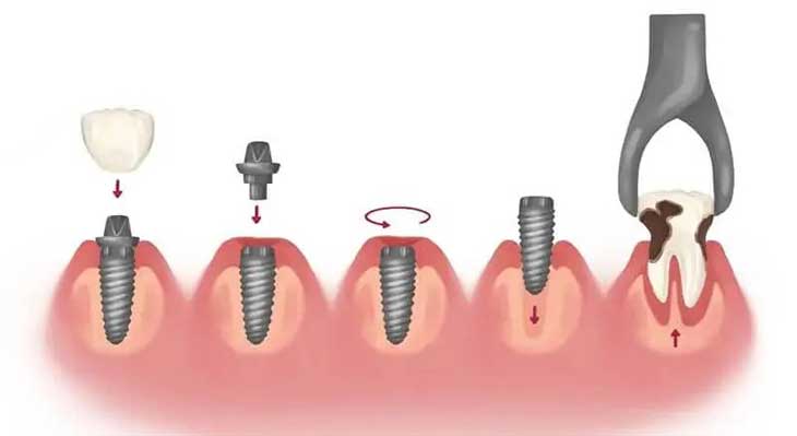 ایمپلنت دو مرحله ای