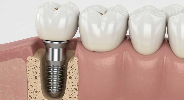 ایمپلنت اندواستیل