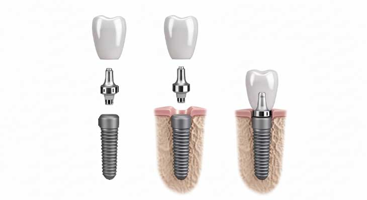 ایمپلنت تک مرحله ای