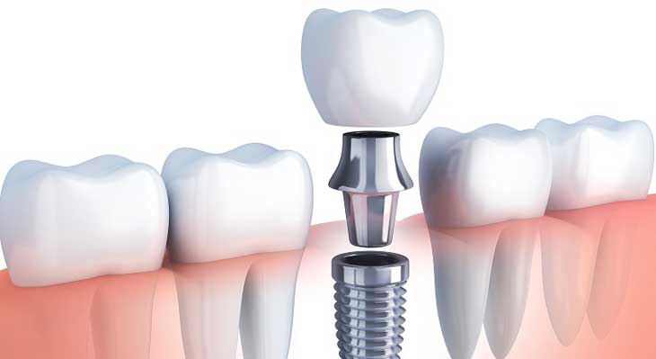 ایمپلنت تک مرحله ای