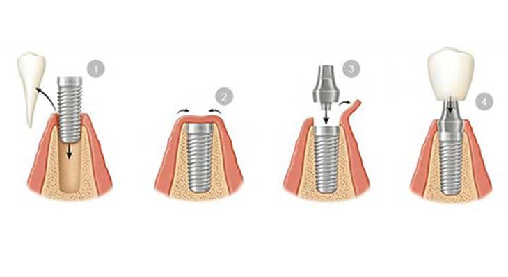 ایمپلنت دو مرحله ای