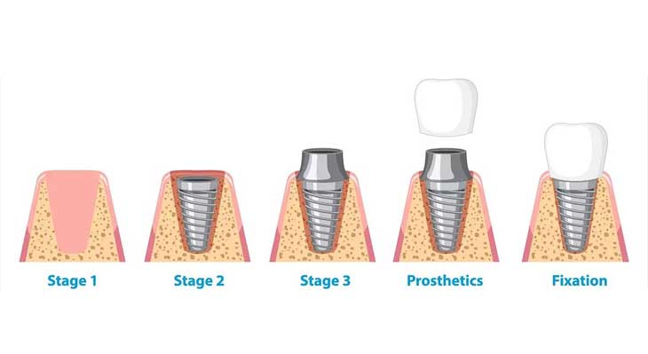 ایمپلنت دو مرحله ای