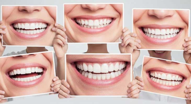 سن مناسب برای کامپوزیت دندان