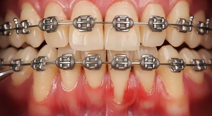 تحلیل لثه در ارتودنسی