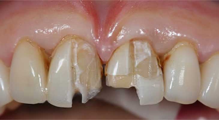 ترمیم لمینت دندان