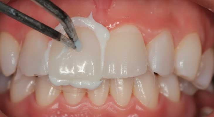 تعویض کامپوزیت دندان