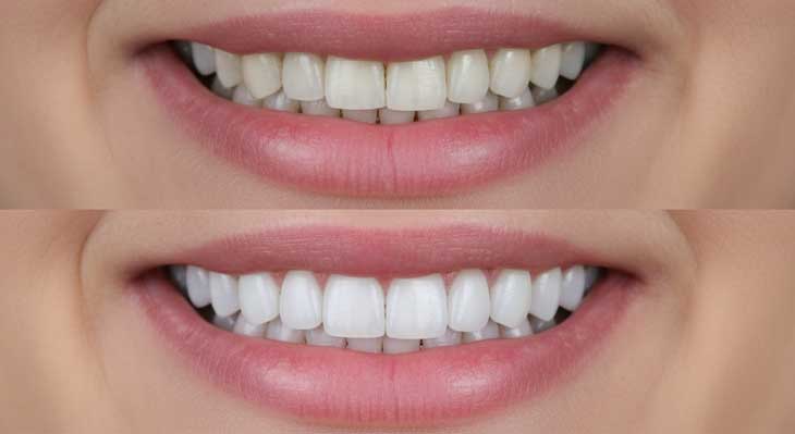 تعویض کامپوزیت دندان