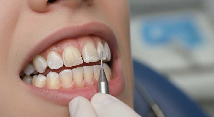 برداشتن کامپوزیت دندان