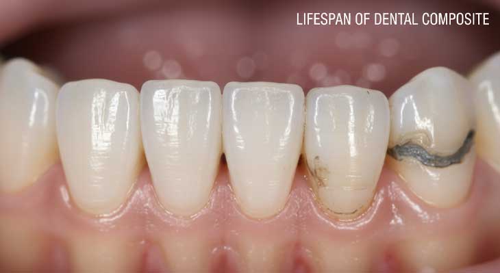 طول عمر کامپوزیت دندان
