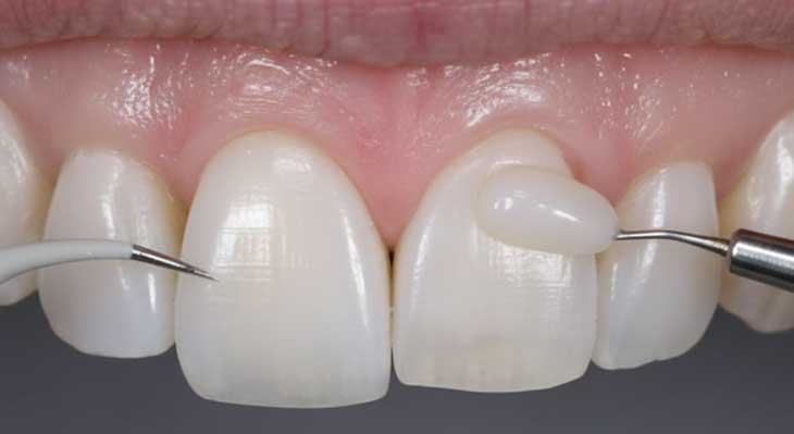 تعویض کامپوزیت دندان