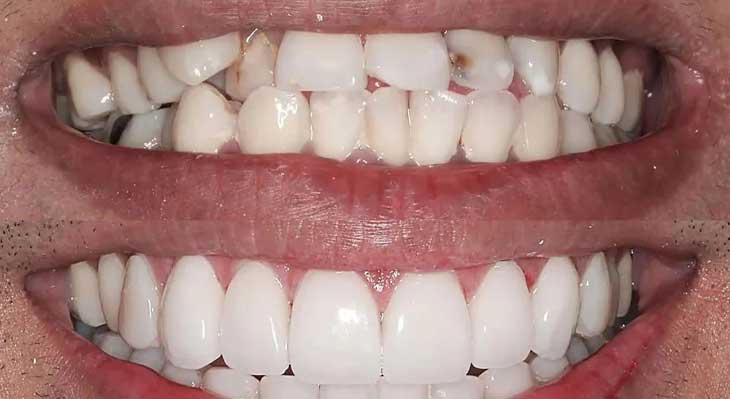 کامپوزیت دندان کج و نامرتب