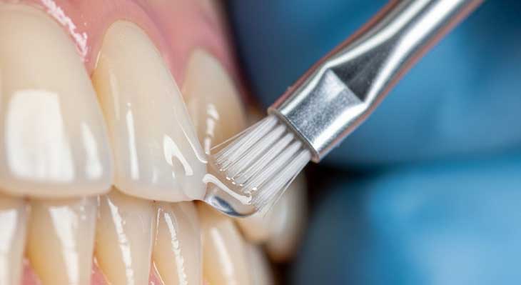 وارنیش فلوراید