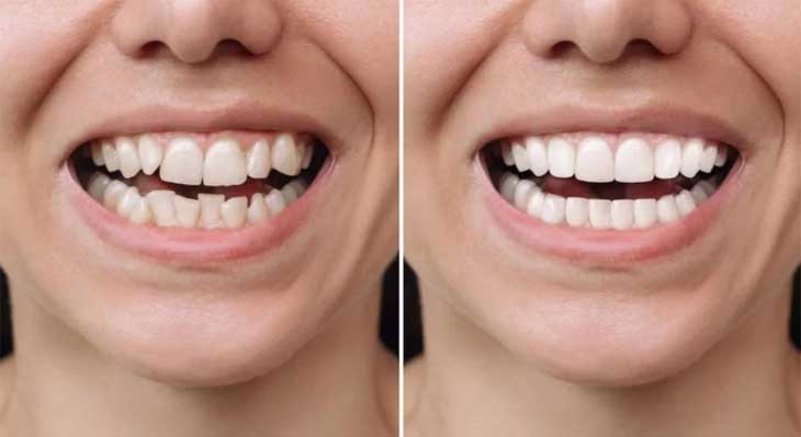 کامپوزیت دندان کج و نامرتب