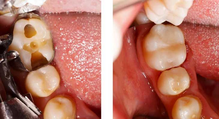 کامپوزیت دندان در دندان های عقب