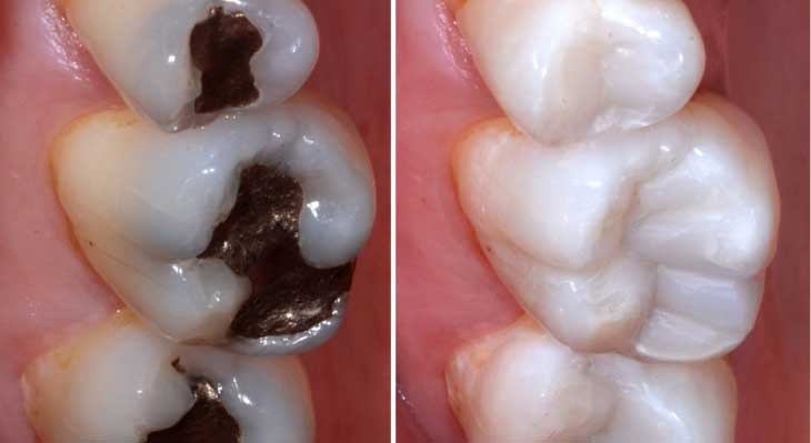 کامپوزیت دندان در دندان های عقب