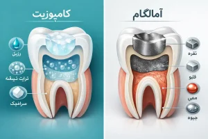 دوام کامپوزیت در مقابل آمالگام