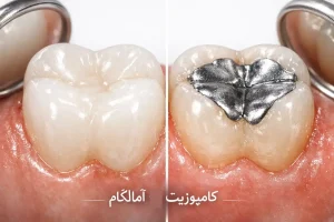 هزینه کامپوزیت و آمالگام چقدر است؟
