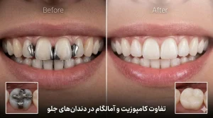 تفاوت کامپوزیت و آمالگام در دندان های جلو و عقب