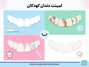 آیا لمینت دندان کودکان باعث آسیب به دندان می شود؟