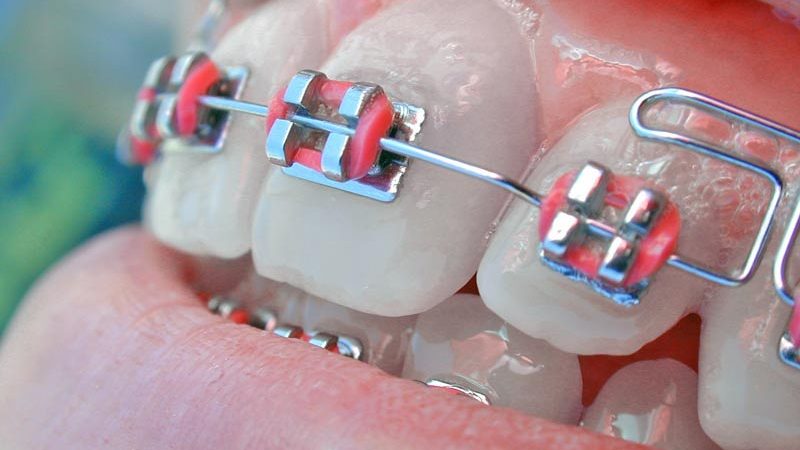ارتودنسی چگونه دندان ها را صاف می کند؟